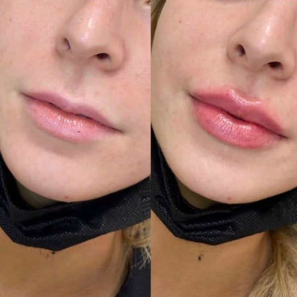Before using LIPCARE